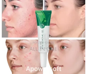 Aloe Vera Acne Removal Gel